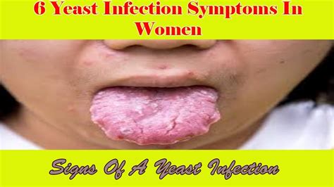 6 Yeast Infection Symptoms In Women - Signs Of A Yeast Infection - YouTube