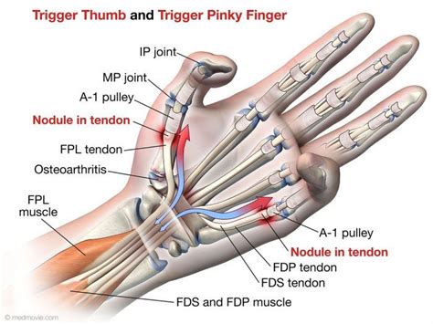 Trigger Finger Fort Worth, TX - The Hand to Shoulder Center