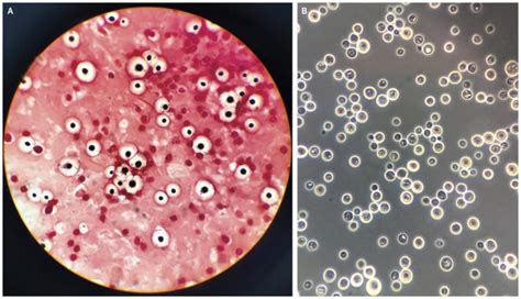 Cryptococcus neoformans- An Overview