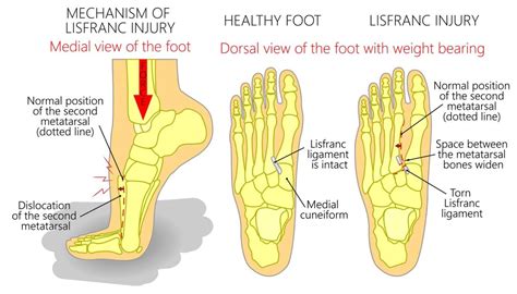 Do you have a Bump on Top of the Foot? [Hard, Painful or Bone Bump]