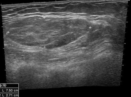 Axillary Lipoma Ultrasound