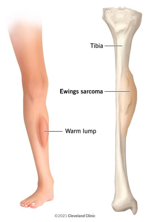 Ewing Sarcoma - Orthopedics Notes