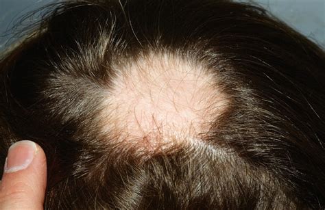 Alopecia areata causes, symptoms and best treatment for alopecia areata