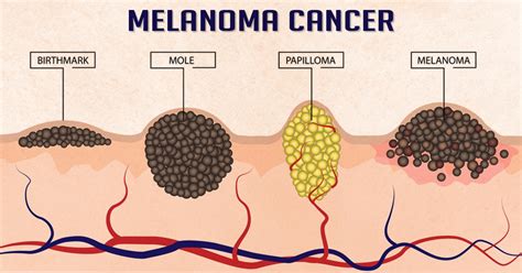 Melanoma cancer (skin cancer)- healthreactive.com :: Health Reactive ...