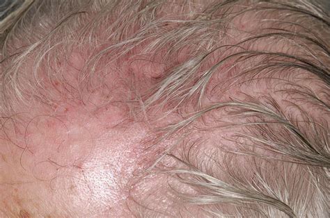 Scalp Irritation After Shingles Photograph by Dr P. Marazzi/science ...