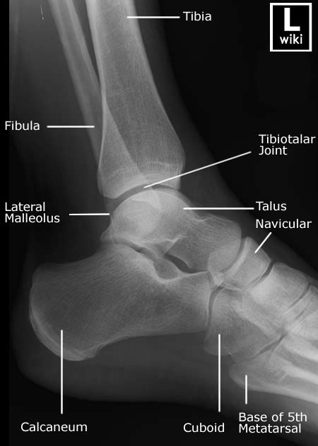 emDOCs.net – Emergency Medicine EducationDiagnostic accuracy of ankle x ...