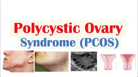 Polycystic Ovary Syndrome (PCOS): Symptoms, Cause, and Treatment - The ...