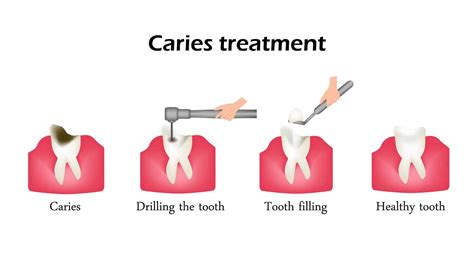 Detecting and Treating Tooth Decay | Simply Dental Chatswood