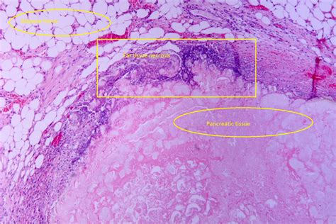 Chronic pancreatitis pathophysiology - wikidoc