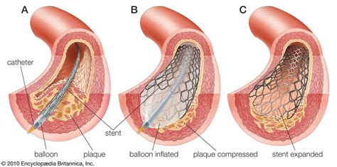 Atherosclerosis | Description, Pathophysiology, Risk Factors ...