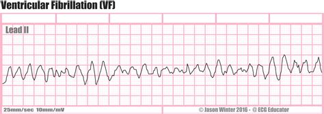 ECG Educator Blog : Ventricular Fibrillation (VF)