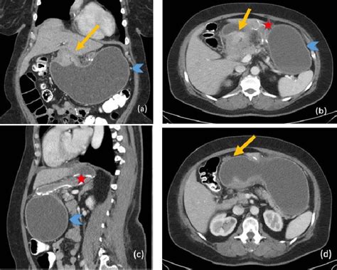 Cureus | Exploring the Excluded Stomach: A Case Series of Novel ...