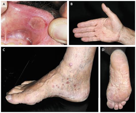 Primary and Secondary Syphilis | NEJM