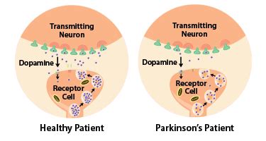 Understanding Parkinson's Disease | Brain Institute | OHSU