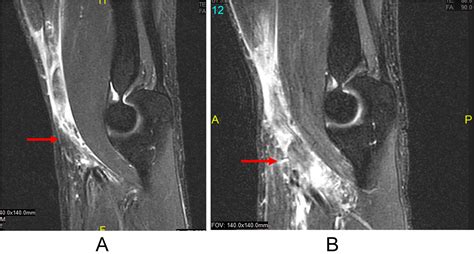 Bilateral Simultaneous Distal Biceps Rupture: A Case Report and Review ...