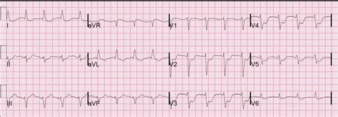 Dr. Smith's ECG Blog: Beware confusing the diagnosis of posterior STEMI ...