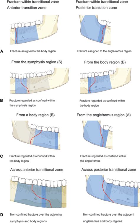 Mandible Fracture Classification