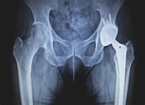 Hip Replacement Operational Procedure - docOPD