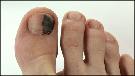 7 Proven Ways To Get Rid Of Black Toenail Fungus | Black toenail fungus ...