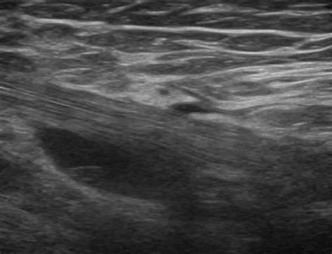 Musculoskeletal Joints and Tendons | 6.2 Elbow : Case 6.2.8 Distal ...