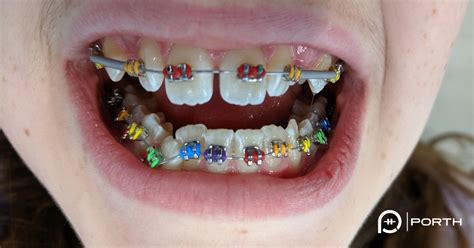 Braces Colors For Teeth