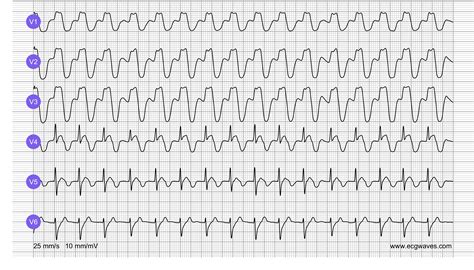 ECG Test - Quiz 4 - Mixed Conditions – Cardiovascular Education