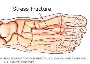 Pain on Top of Foot: Causes, Symptoms & Treatment