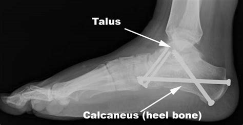 Triple Arthrodesis - Drwolgin