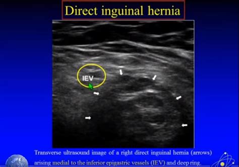 www.tomwademd.net ultrasound-imaging-of-hernia-parts-1-2-of-4-a-youtube ...