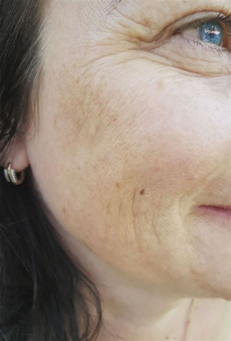 Unmasking the causes and treatments of melasma - Harvard Health