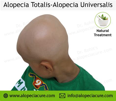 Alopecia Universalis