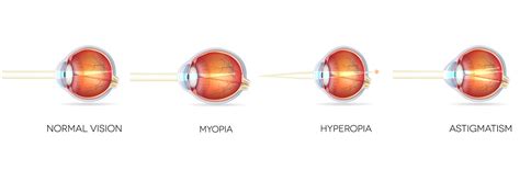 Eyesight: What is Short, Long Sight & Astigmatism? - We Fix Eyes