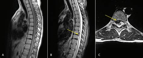 Herniated Disc Thoracic Mri