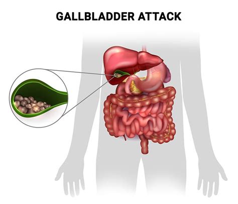 How to Recognize the Symptoms of a Gallbladder Attack - Manhattan ...