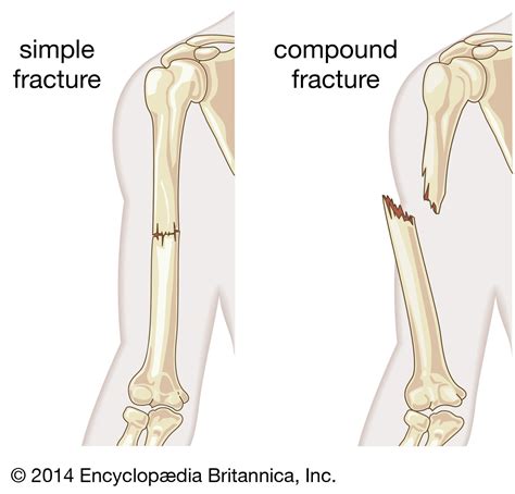 Compound fracture | pathology | Britannica