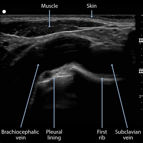 Ultrasound-Guided Subclavian Vein Cannulation: Procedures ...