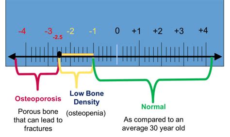 Osteoporosis - Mitch Lenkic Sports Physiotherapy