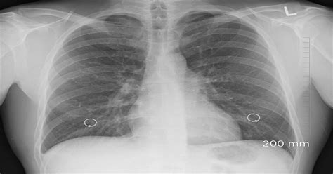 Pleural Mesothelioma (MPM) - Symptoms, Diagnosis, Staging & Treatment ...