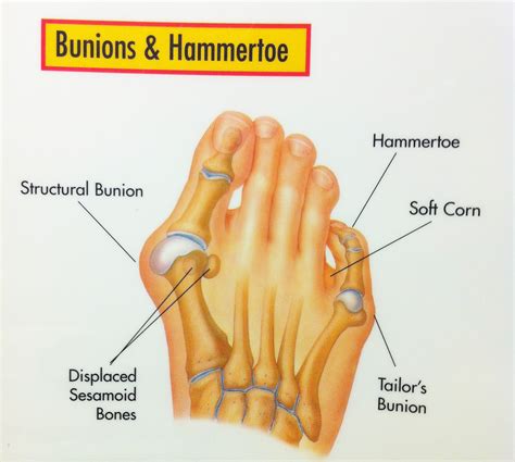 Bunions | Foot & Ankle Doctors, Inc.