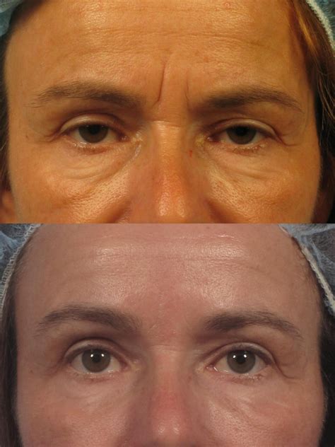 Wrinkle Treatment Fillers NYC | Botox | Microneedling - Dr. Brett Kotlus