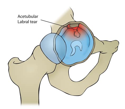 Acetabular Labrum