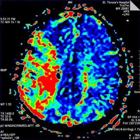 Metachromatic leukodystrophy | Canada| PDF | PPT| Case Reports ...