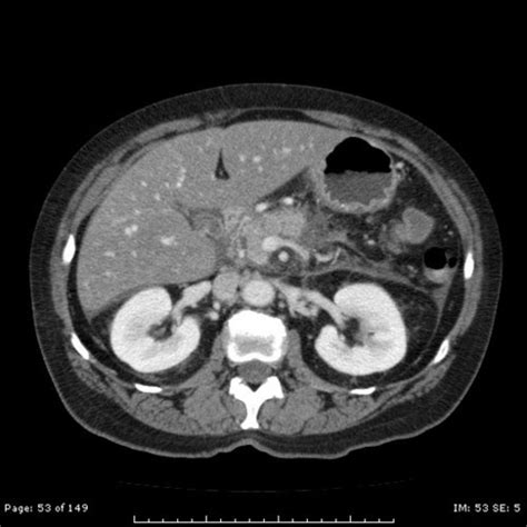 What Is the Contrast Dye Used in CT Scans? | HealDove