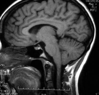 Mri Brain Tumor Pituitary