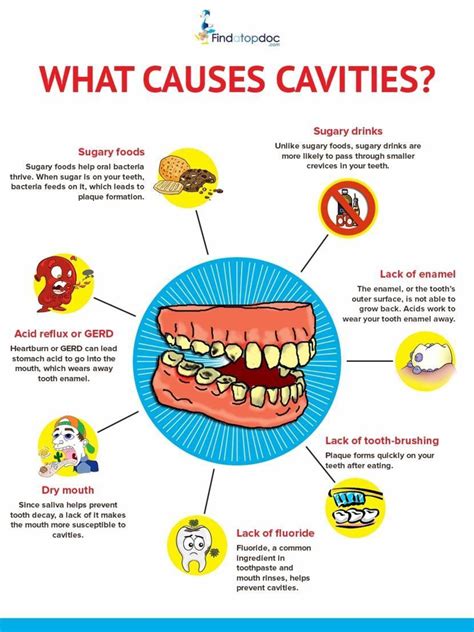 Cavities/ Tooth Decay: Symptoms, Causes, Treatment, and Diagnosis ...