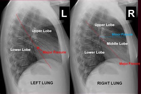 Normal Lung X Ray Lateral