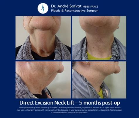 A Different Approach to Platysplasty (Neck Lift) – Direct Excision ...