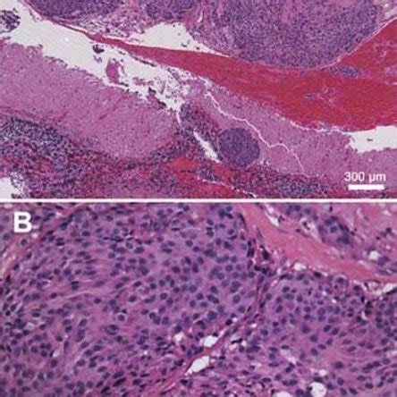 (PDF) Brain metastasis from medullary thyroid carcinoma