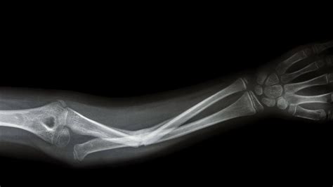 Graphene Shows Promise for Repairing Broken Bones