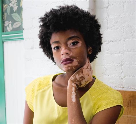 Vitiligo Crusaders | Page 41 | Meet the face behind 'Vitiligo Baker'